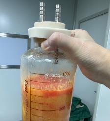 聊城水动力吸脂手术要做多久？